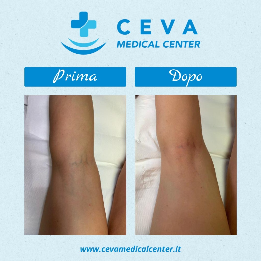 Excelv cutera ceva medical center