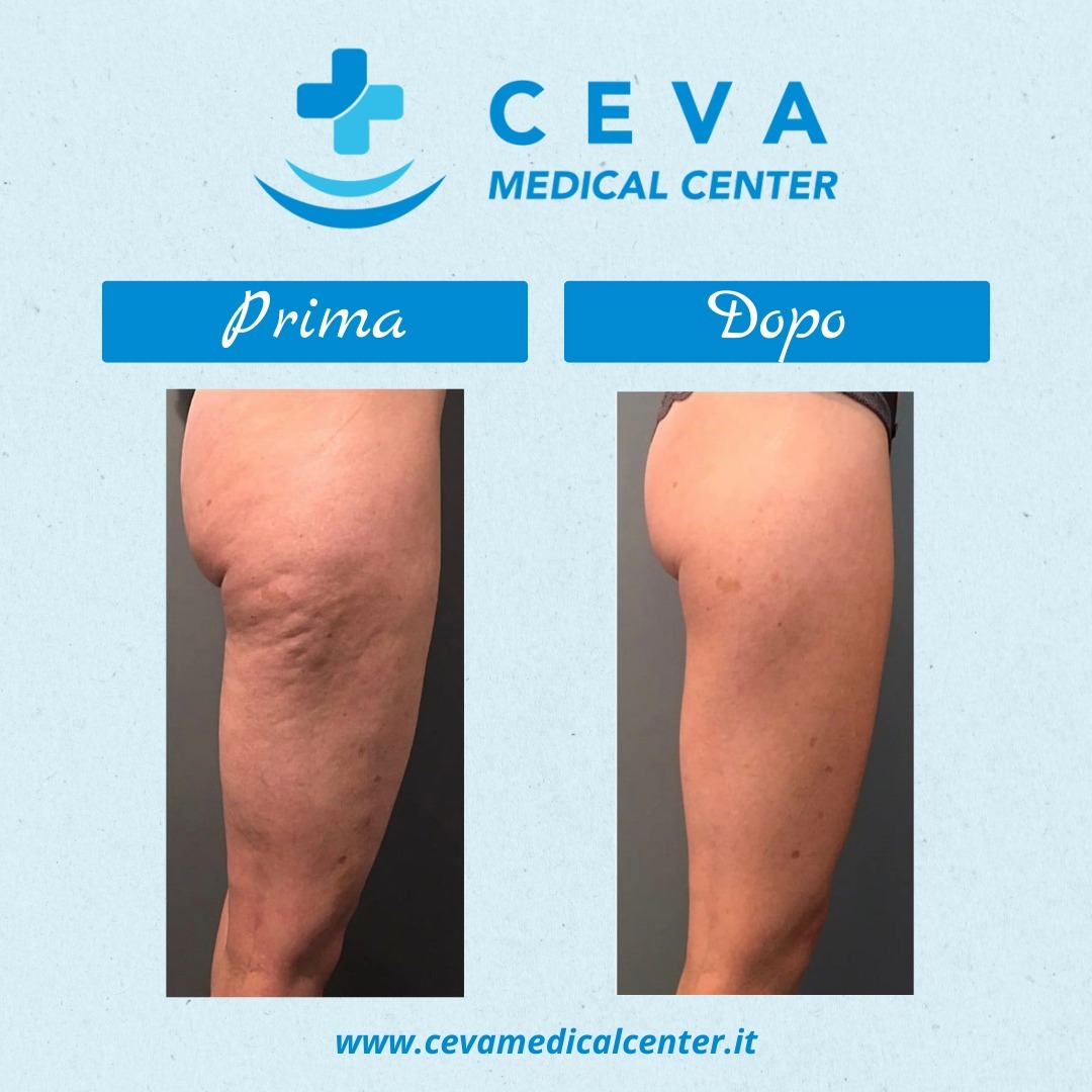 Excelv cutera ceva medical center