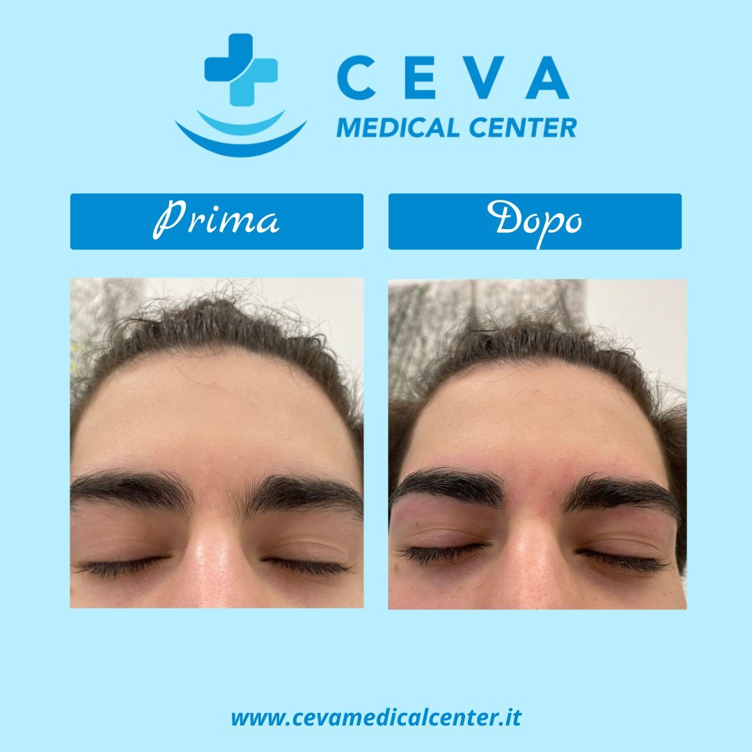 Excelv cutera ceva medical center