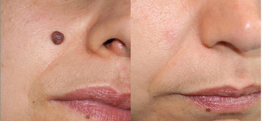 filler ceva medical center