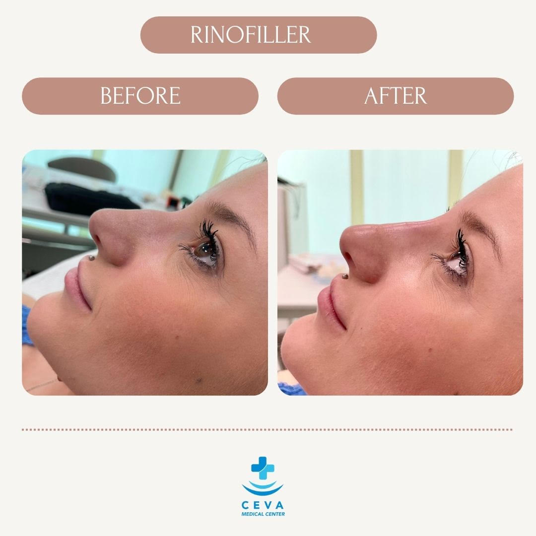 filler ceva medical center